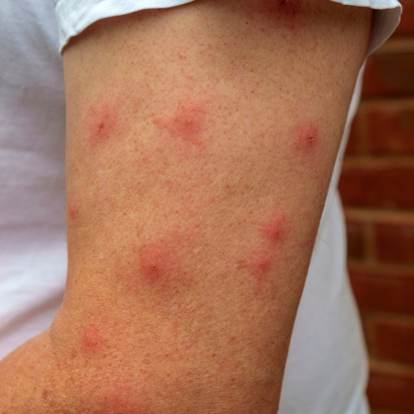Piqures de moustiques sur le bras